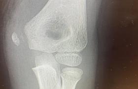 Fracture épitrochlée