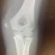 Fracture épitrochlée