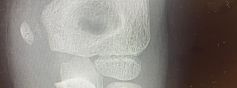 Fracture épitrochlée