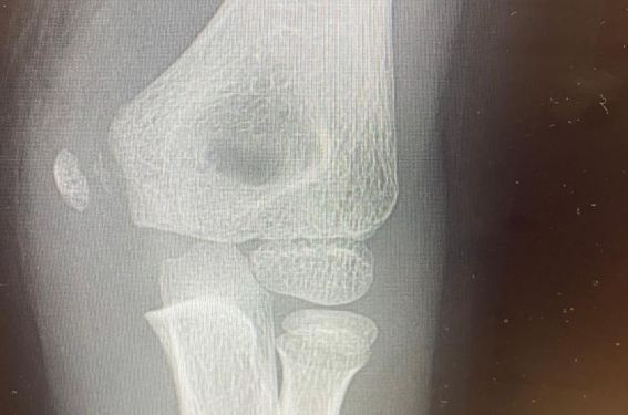 Fracture épitrochlée